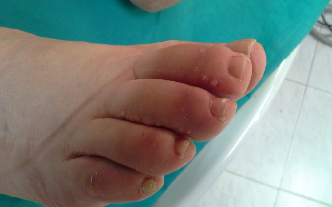 Conceptos básicos del linfedema