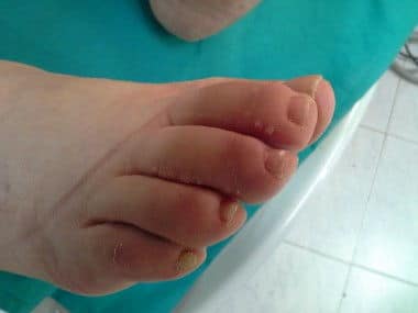 BASIC CONCEPTS OF THE LYMPHEDEMA