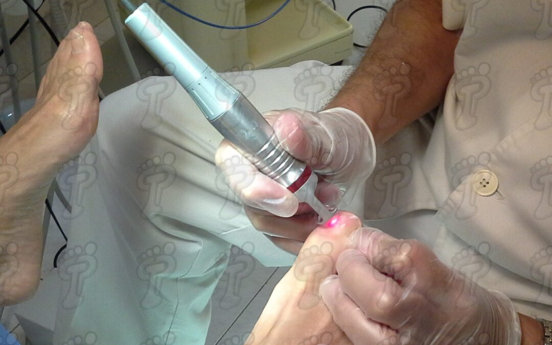 Estudio comparativo del tratamiento láser en onicomicosis versus tratamiento combinado de laserterapia y antimicótico tópico