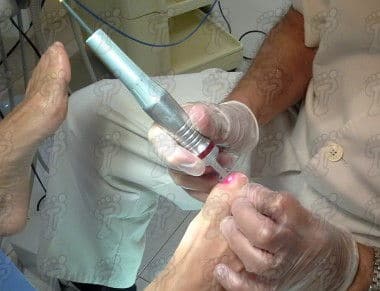 Estudi comparatiu del tractament làser en onicomicosi versus tractament combinat de laserteràpia i antimicòtic tòpic