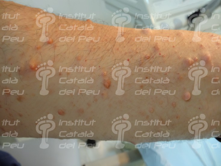 Descripción de la esclerosis tuberosa