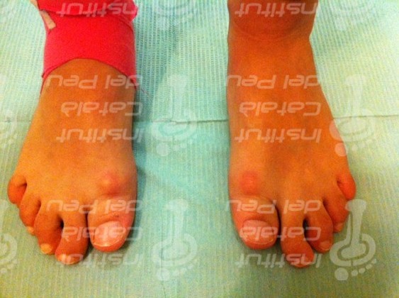 Falange proximal bipartita