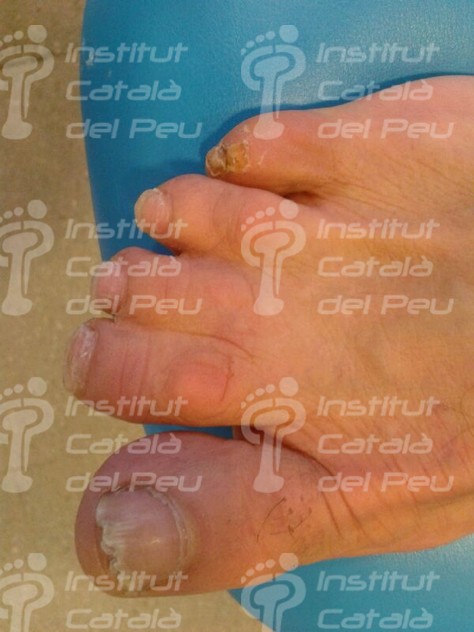 La sindactilia, malformación congénita en la fase de diferenciación