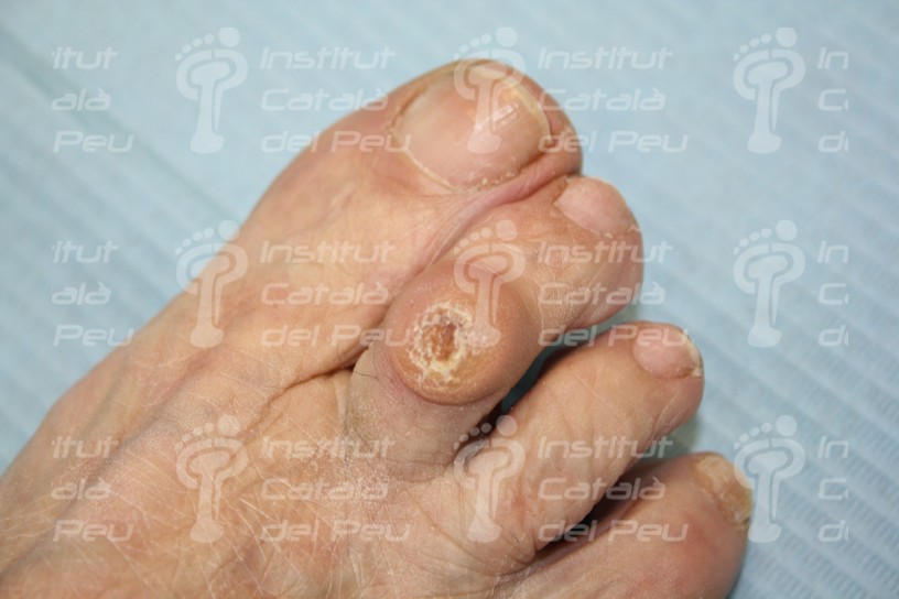 DEFORMIDAD DIGITAL: ABORDAJE QUIRURGICO MEDIANTE ARTROPLASTIA DE LA FALANGE PROXIMAL