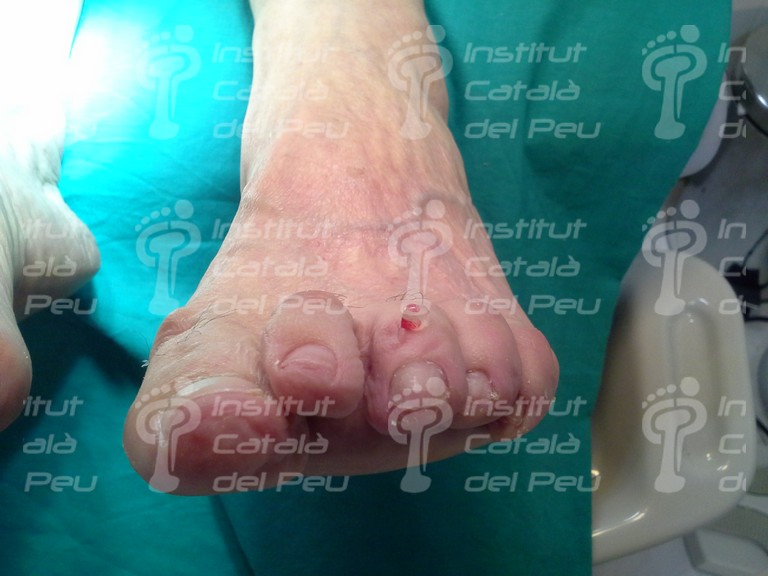 Descripción del quiste mixoide o mucoide digital