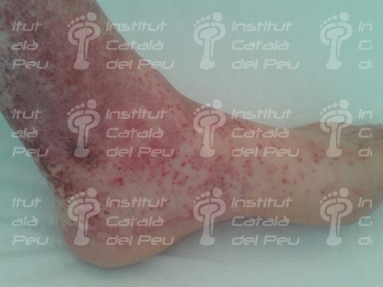 Conceptos generales de la vasculitis