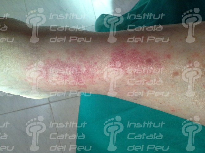 Picadas o mordeduras de arácnidos e insectos