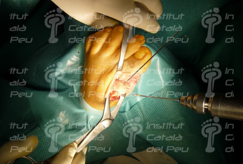 TRATAMIENTO QUIRÚRGICO DEL HALLUX RÍGIDUS