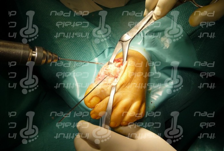 Хирургическое лечение ригидного первого пальца стопы (Hallux Rigidus)