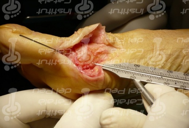 Хирургическое лечение ригидного первого пальца стопы (Hallux Rigidus)