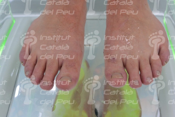 THE HYPERHIDROSIS. THE EXCESSIVE INCREASE OF THE SWEAT PRODUCTION.