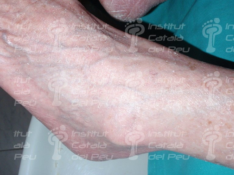 Xerosis Severe Dryness Of The Skin Institut Catala Del Peu