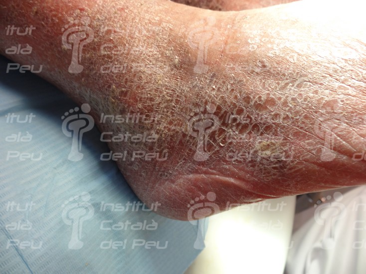 La xerosis: sequedad severa de la piel