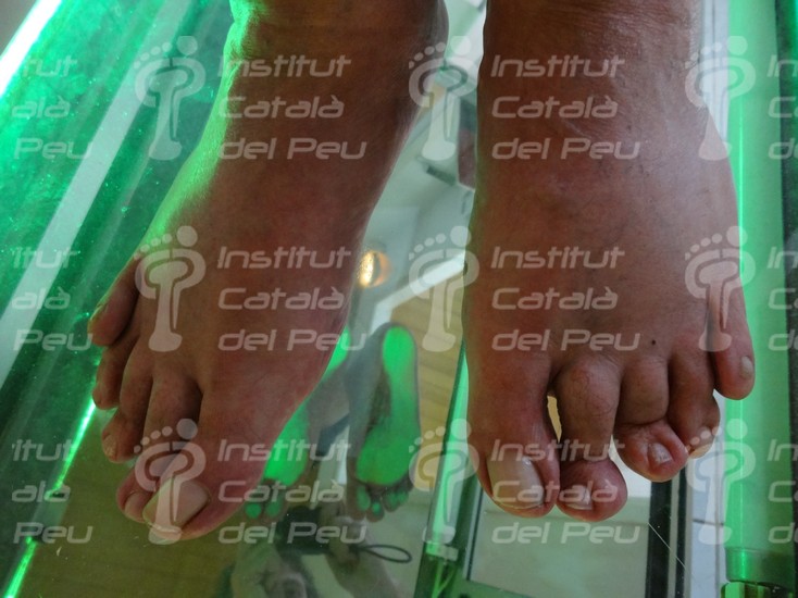 El quinto dedo supraducto. Conceptos básicos