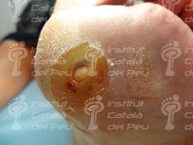 El mal perforante plantar. Complicación grave del pie diabético.