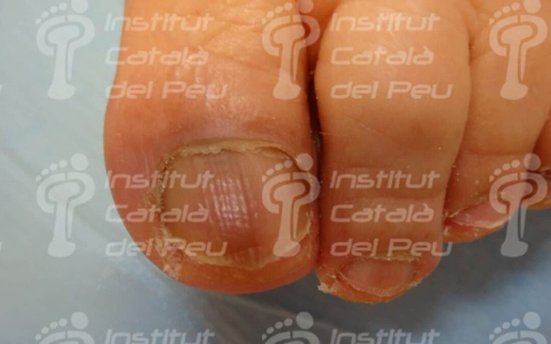 La melanoniquia ungueal. Conceptos básicos