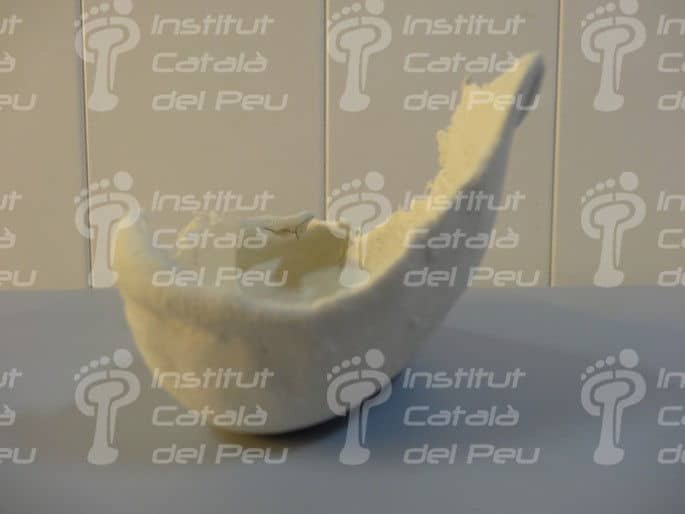 L'agenèsia en l'extremitat inferior