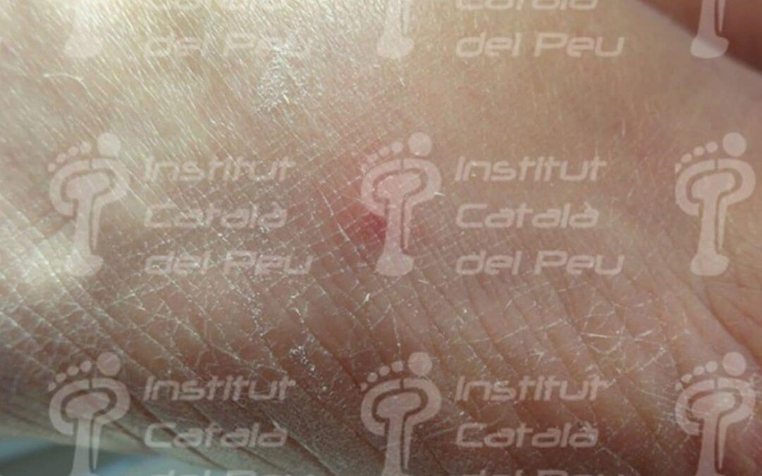 El eritema nodoso. Lesión de hipersensibilidad frente a antígenos.