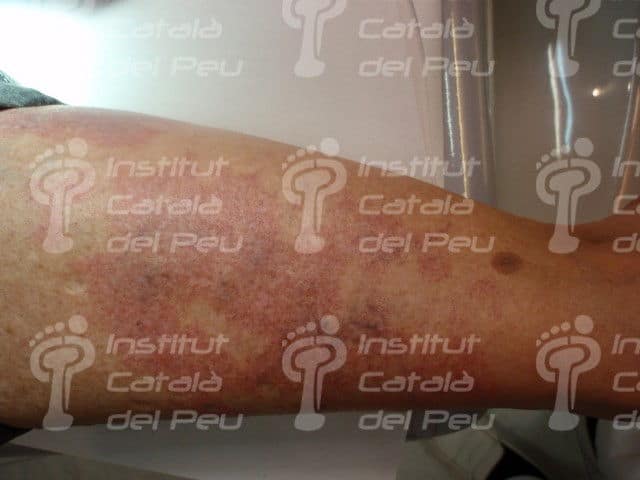 Diferenciació entre l'hemangioma pla i la taca en vi de Porto