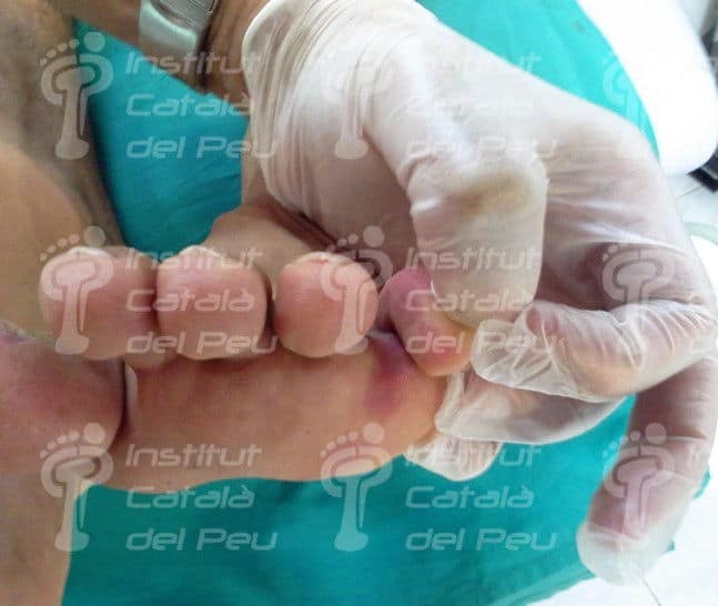 Diferenciació entre l'hemangioma pla i la taca en vi de Porto