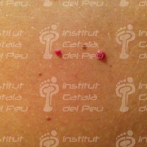 Diferenciació entre l'hemangioma pla i la taca en vi de Porto