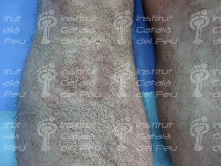 DIFFERENCE BETWEEN THE HEMANGIOMA PLANUM AND THE PORT-WINE STAIN.