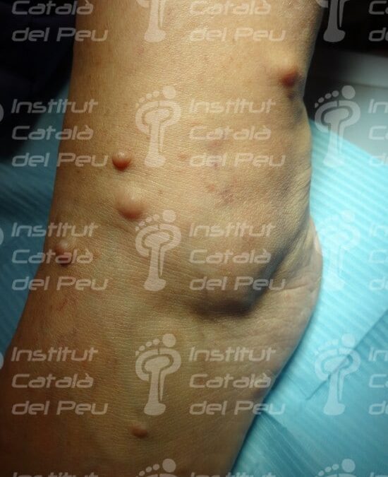 La neurofibromatosis. Causas, clínica y tratamiento.