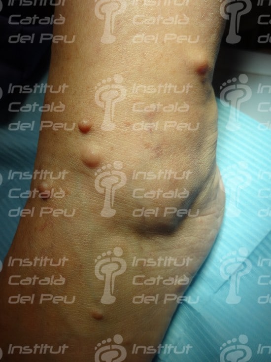La neurofibromatosis. Causas, clínica y tratamiento. La neurofibromatosis. Causas, clínica y tratamiento.