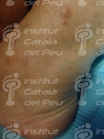 La neurofibromatosis. Causas, clínica y tratamiento.