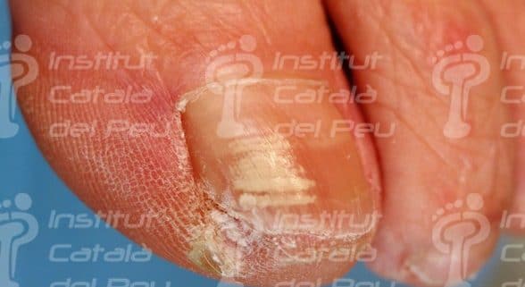 THE LEUKONYCHIA OR “NAILS WITH WHITE SPOTS”. - Institut Català del Peu