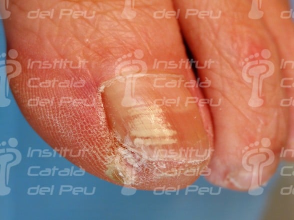 THE LEUKONYCHIA OR “NAILS WITH WHITE SPOTS”. - Institut Català del Peu