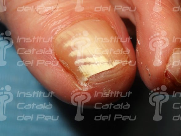tetraedro Prescribir bombilla La leuconiquia o "uñas con manchas blancas". - Institut Català del Peu