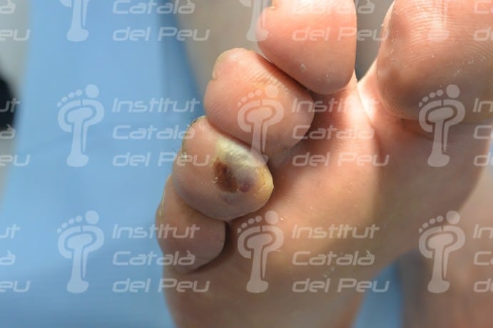 Ampollas: Causas, clínica y tratamiento.