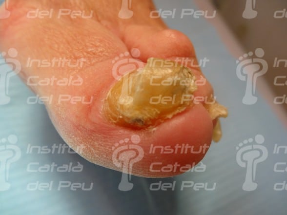 L’onicogrifosi o l’augment del gruix de les ungles