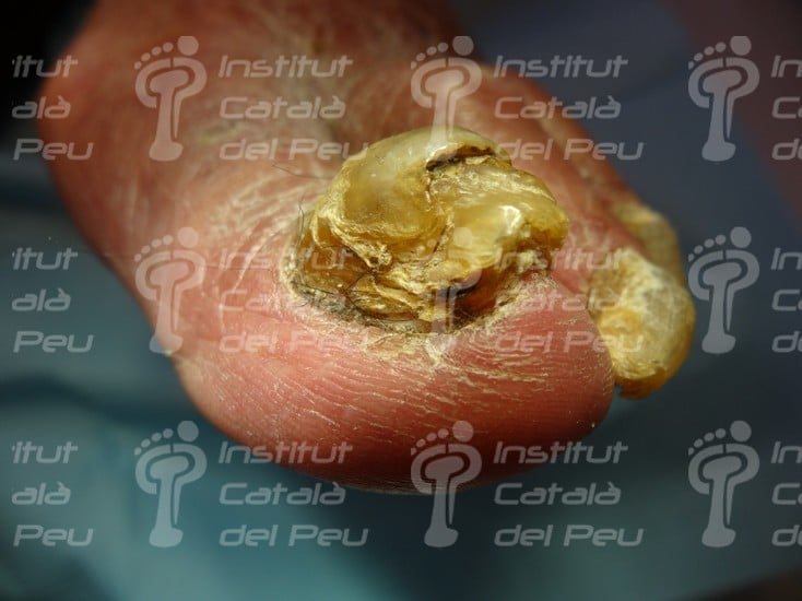 THE ONYCHOGRYPHOSIS OR THE INCREASE OF THE NAILS’ THICKNESS.