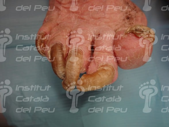 L’onicogrifosi o l'augment del gruix de les ungles