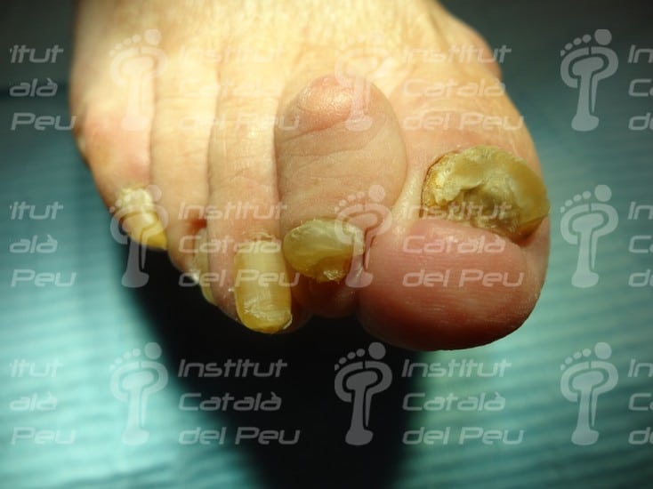 L’onicogrifosi o l'augment del gruix de les ungles