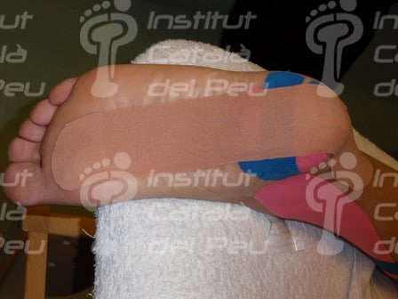 Fascitis plantar: síntomas y tratamiento