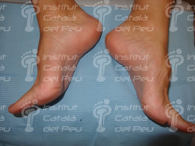 PLANTAR FASCITIS: SYMPTOMS AND TREATMENT.