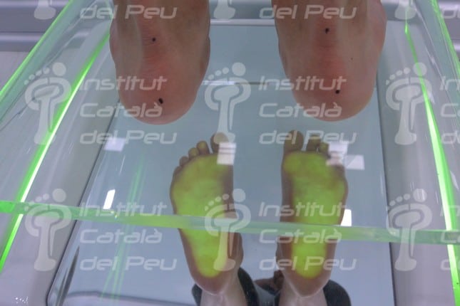 Fascitis plantar: síntomas y tratamiento