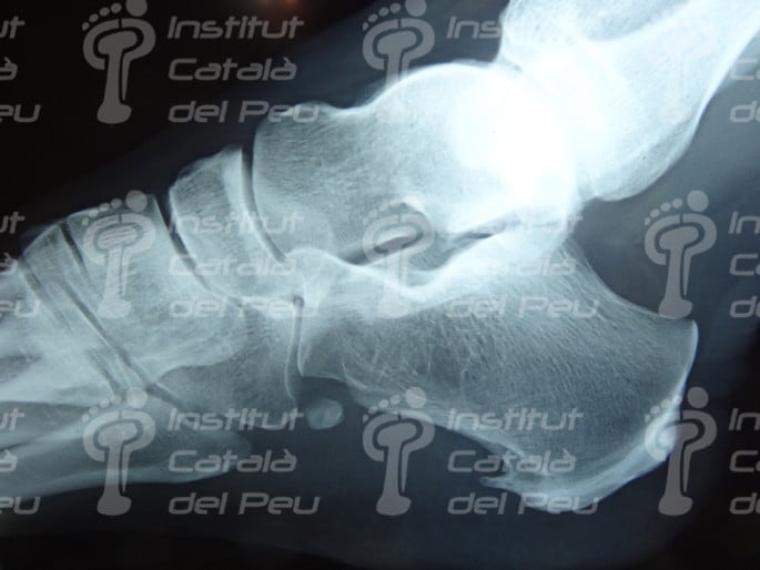 Fascitis plantar: síntomas y tratamiento