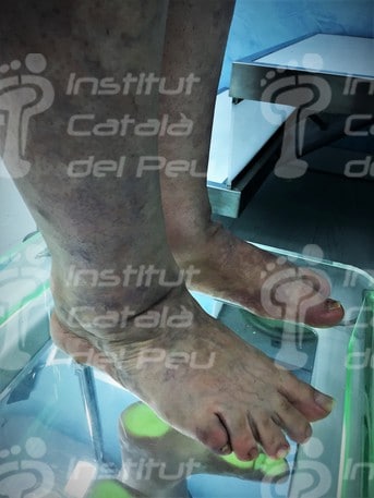 El síndrome de Klippel – Trénaunay – Weber. Definición y características.