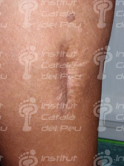 El tejido cicatricial: características.