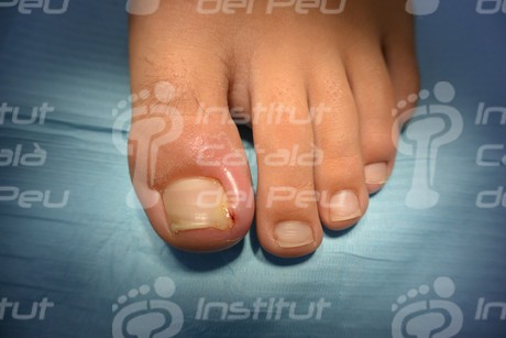 THE ONYCHOCRYPTOSIS OR INGROWN NAIL