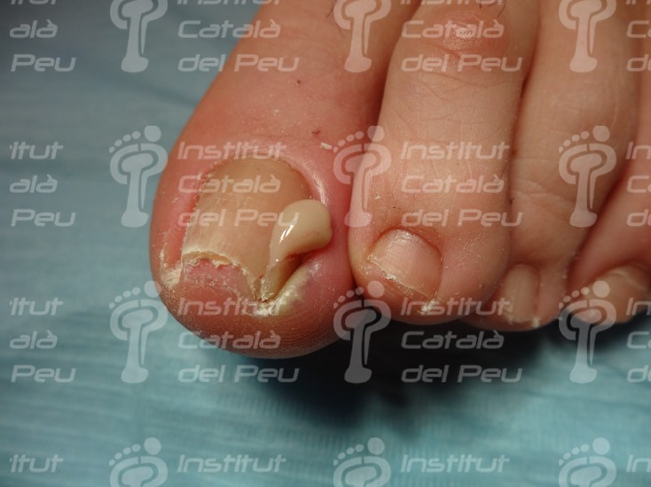 THE ONYCHOCRYPTOSIS OR INGROWN NAIL