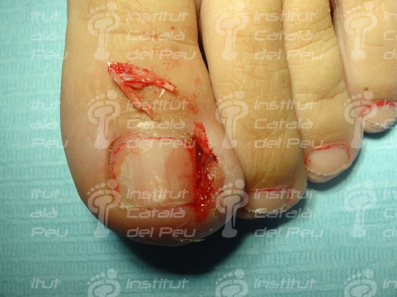 THE ONYCHOCRYPTOSIS OR INGROWN NAIL