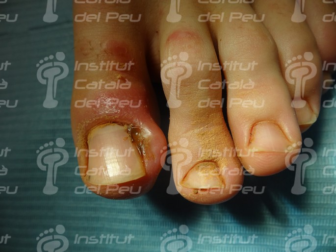 THE ONYCHOCRYPTOSIS OR INGROWN NAIL