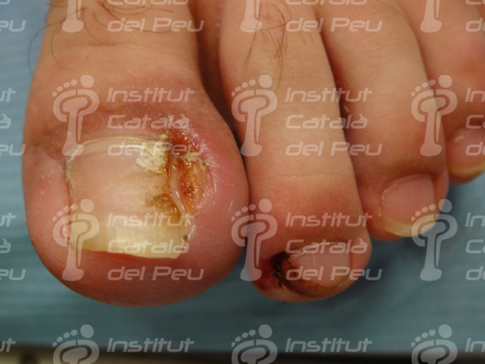 THE ONYCHOCRYPTOSIS OR INGROWN NAIL