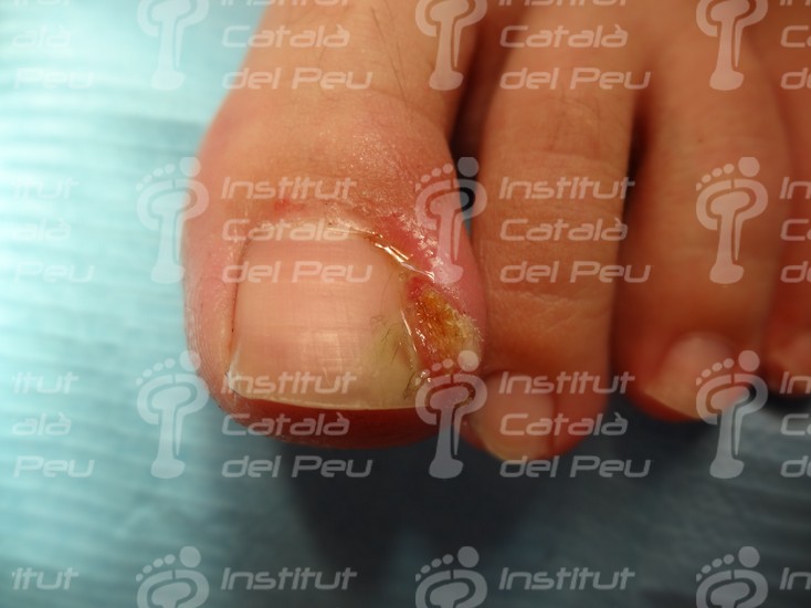 THE ONYCHOCRYPTOSIS OR INGROWN NAIL