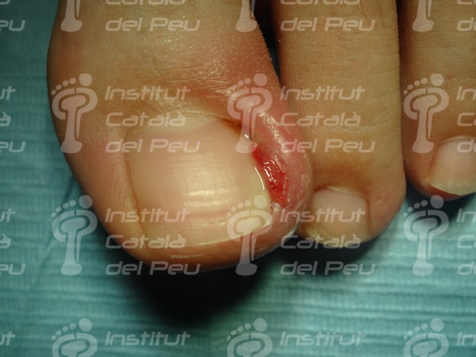 La Onicocriptosis o uña encarnada